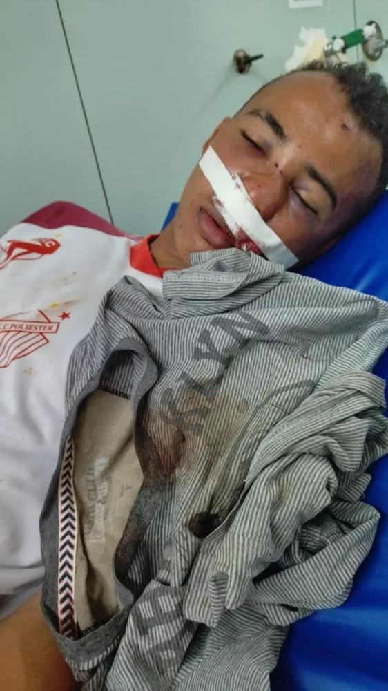 Jovem quebrou o nariz e está com cirurgia marcada — Foto: Arquivo Pessoal