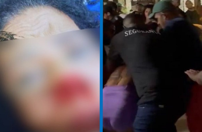 O médico plantonista informou à PM que o objetivo será passar a vítima por uma cirurgia plástica para reconstruir o nariz lesionado pela mordida.