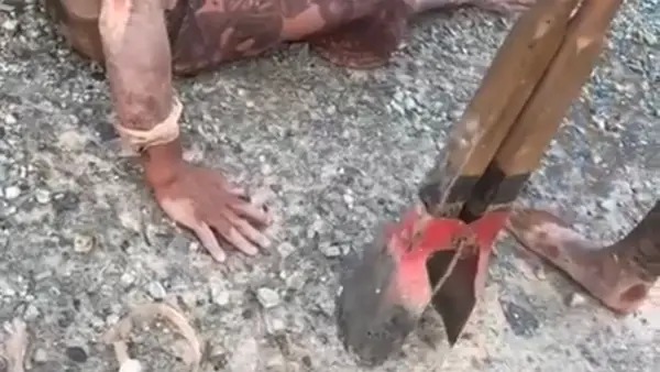 O homem teve todos os dedos da mão direita decepados