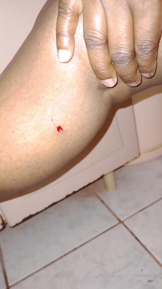 Cuidadora de Idoso mostra a mordida que levou de um cão em situação de rua