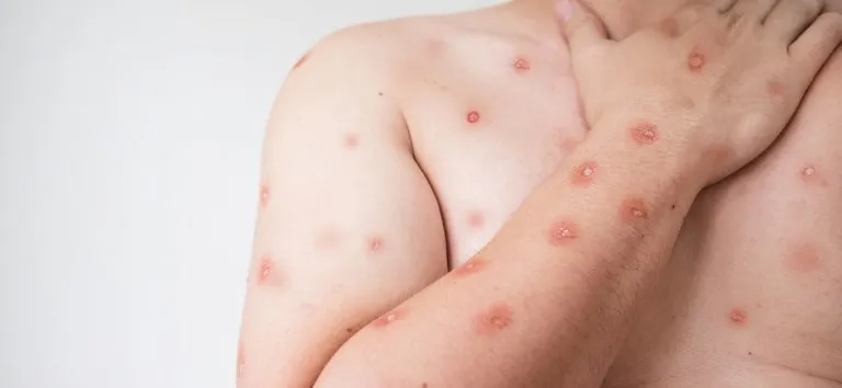 Os primeiros casos de MPox foram diagnosticados no país em 2022