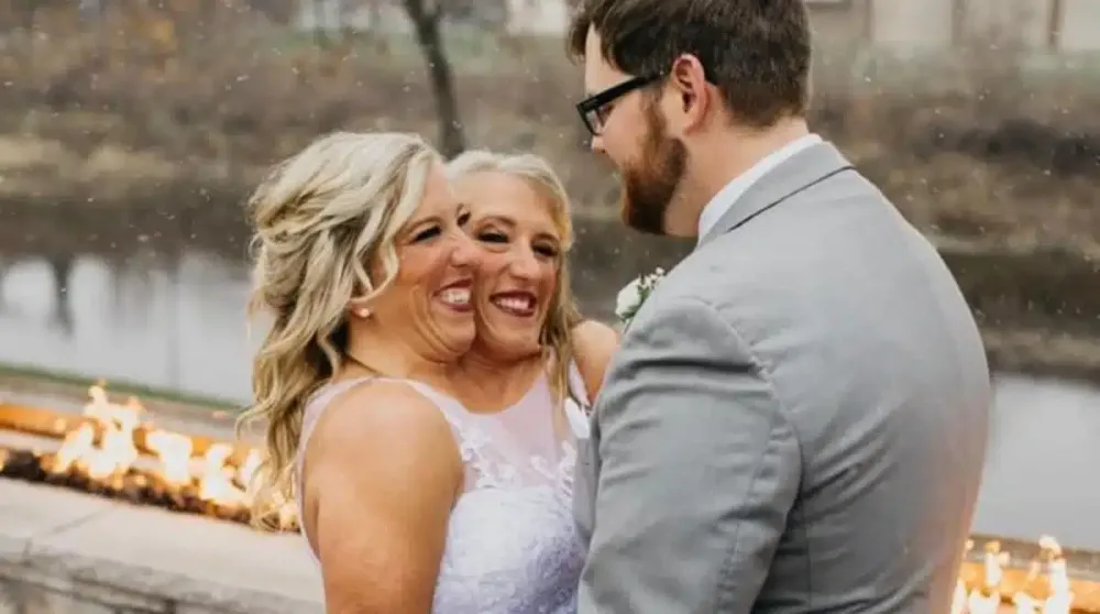 Gêmeas siamesas explicaram o seu casamento