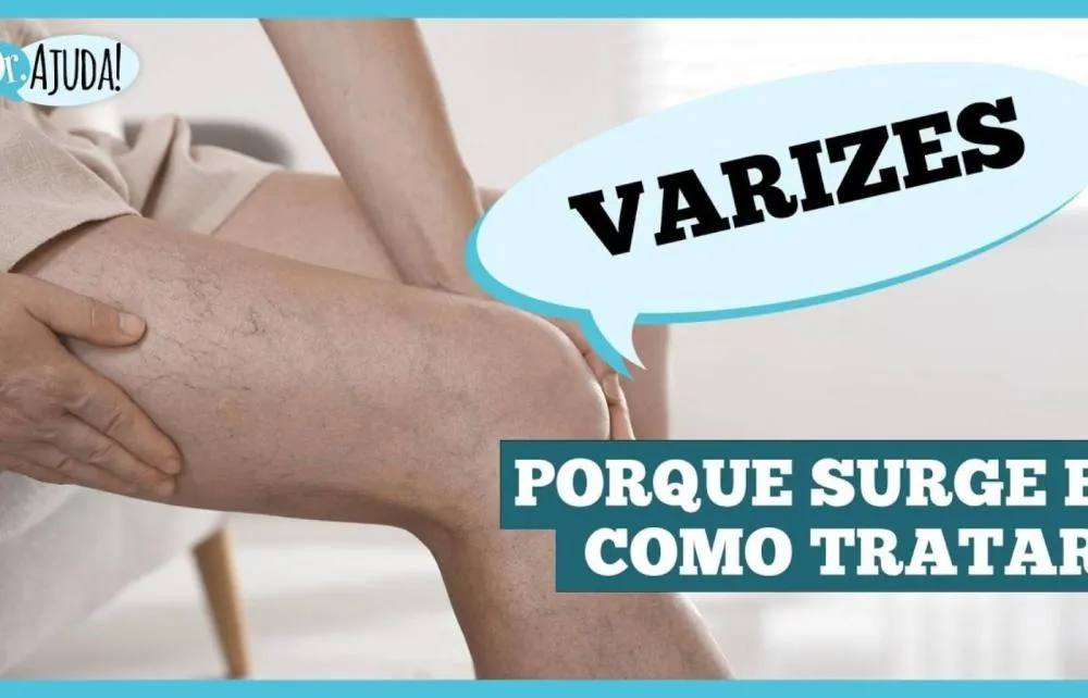 Varizes: não é só estética é saúde vascular