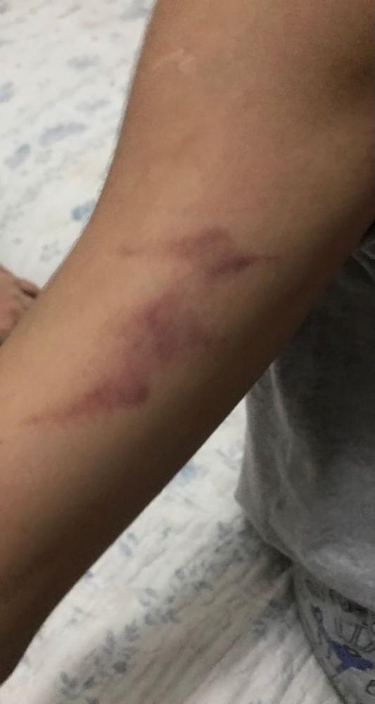 Psicóloga deu beliscões e arranhões no braço da criança