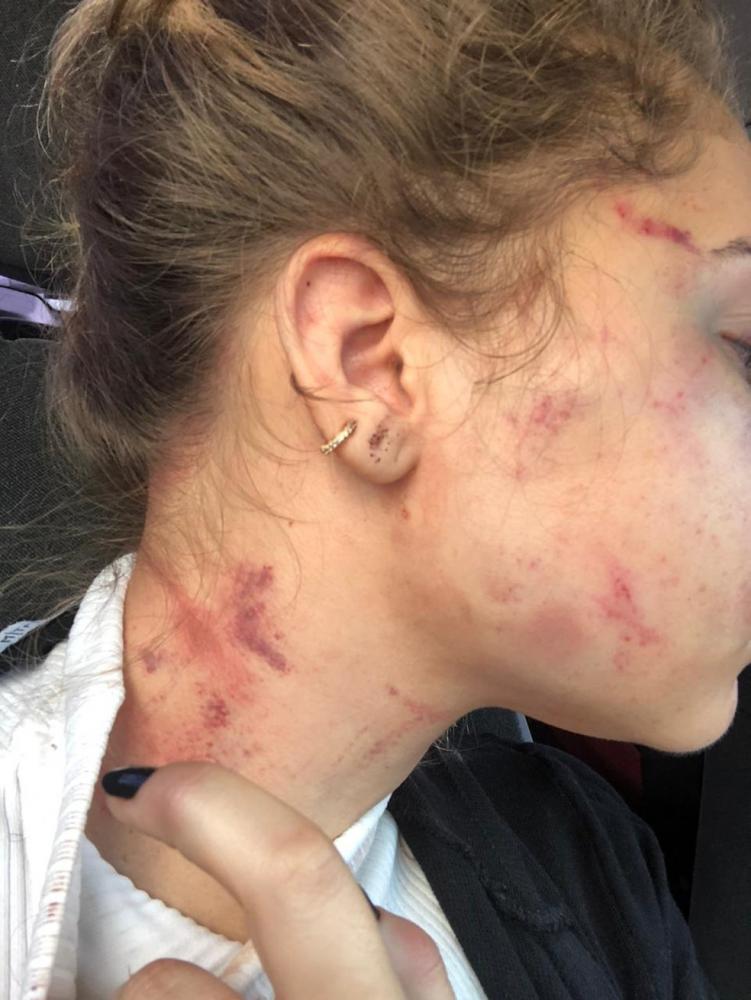 Rayane Machado foi atingida no rosto, pescoço e braços — Foto: Rayane Machado/Arquivo Pessoal