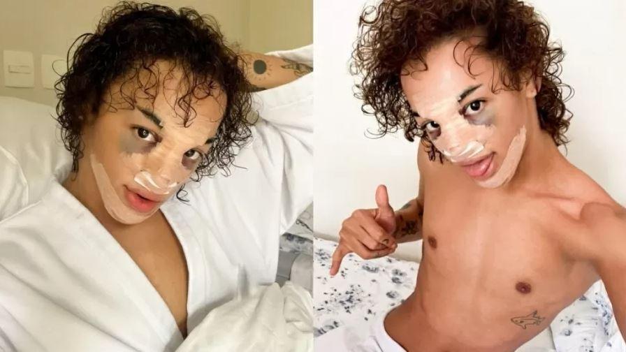 Pabllo Vittar mostra rosto com hematomas após rinoplastia Foto: Reprodução Redes Sociais